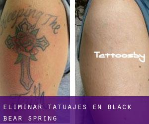 Eliminar tatuajes en Black Bear Spring