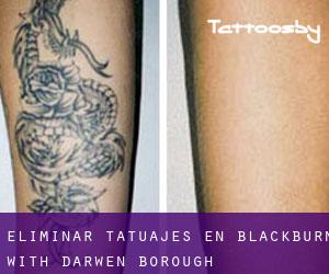 Eliminar tatuajes en Blackburn with Darwen (Borough)