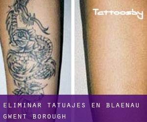 Eliminar tatuajes en Blaenau Gwent (Borough)