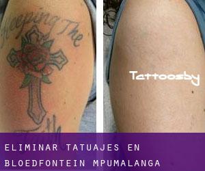 Eliminar tatuajes en Bloedfontein (Mpumalanga)