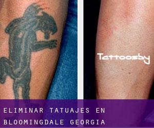 Eliminar tatuajes en Bloomingdale (Georgia)