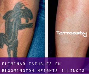 Eliminar tatuajes en Bloomington Heights (Illinois)