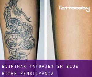 Eliminar tatuajes en Blue Ridge (Pensilvania)