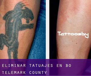 Eliminar tatuajes en Bø (Telemark county)