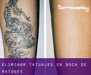 Eliminar tatuajes en Boca de Ratones
