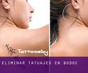Eliminar tatuajes en Bodoc