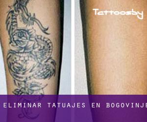 Eliminar tatuajes en Bogovinje
