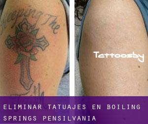 Eliminar tatuajes en Boiling Springs (Pensilvania)
