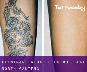 Eliminar tatuajes en Boksburg North (Gauteng)