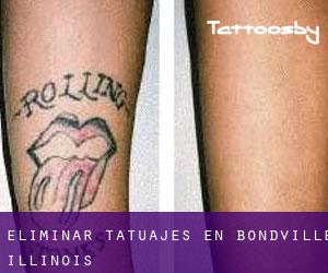 Eliminar tatuajes en Bondville (Illinois)