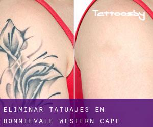 Eliminar tatuajes en Bonnievale (Western Cape)