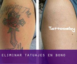Eliminar tatuajes en Bono