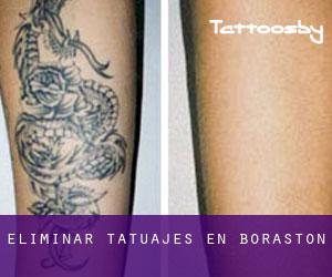 Eliminar tatuajes en Boraston