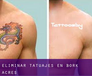 Eliminar tatuajes en Bork Acres