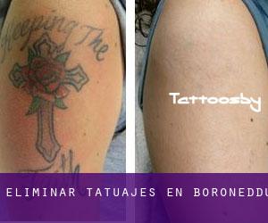Eliminar tatuajes en Boroneddu