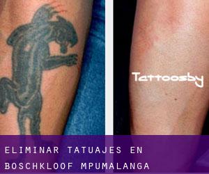 Eliminar tatuajes en Boschkloof (Mpumalanga)
