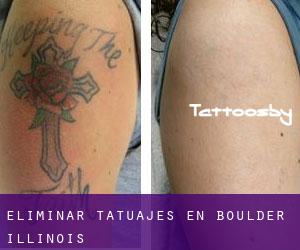 Eliminar tatuajes en Boulder (Illinois)
