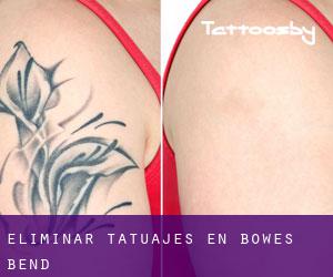 Eliminar tatuajes en Bowes Bend