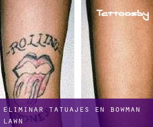 Eliminar tatuajes en Bowman Lawn