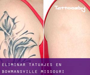 Eliminar tatuajes en Bowmansville (Missouri)