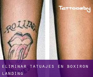 Eliminar tatuajes en Boxiron Landing