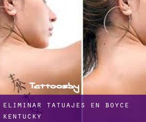 Eliminar tatuajes en Boyce (Kentucky)