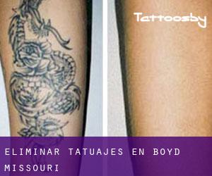 Eliminar tatuajes en Boyd (Missouri)