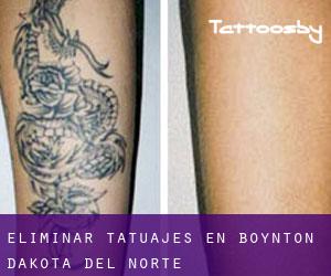 Eliminar tatuajes en Boynton (Dakota del Norte)