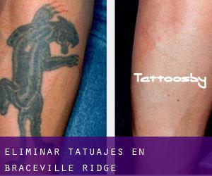 Eliminar tatuajes en Braceville Ridge