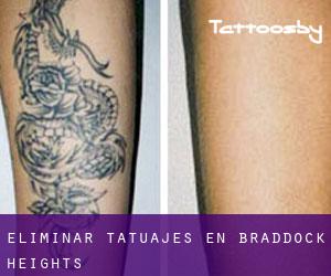 Eliminar tatuajes en Braddock Heights