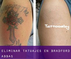 Eliminar tatuajes en Bradford Abbas