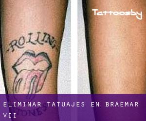 Eliminar tatuajes en Braemar VII