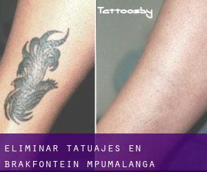 Eliminar tatuajes en Brakfontein (Mpumalanga)
