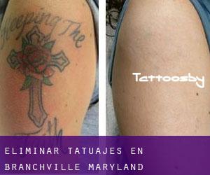Eliminar tatuajes en Branchville (Maryland)