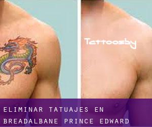 Eliminar tatuajes en Breadalbane (Prince Edward Island)