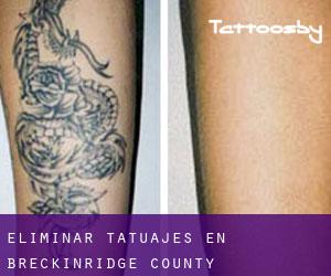 Eliminar tatuajes en Breckinridge County