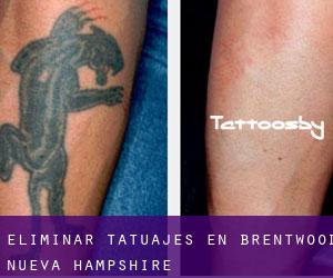 Eliminar tatuajes en Brentwood (Nueva Hampshire)