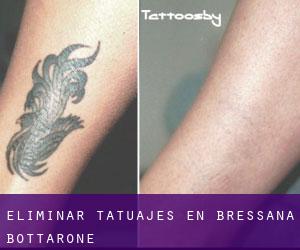 Eliminar tatuajes en Bressana Bottarone