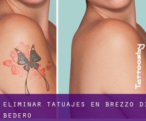 Eliminar tatuajes en Brezzo di Bedero