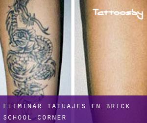 Eliminar tatuajes en Brick School Corner