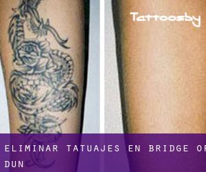 Eliminar tatuajes en Bridge of Dun
