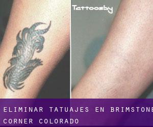 Eliminar tatuajes en Brimstone Corner (Colorado)