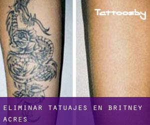 Eliminar tatuajes en Britney Acres