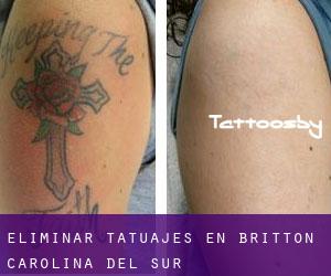Eliminar tatuajes en Britton (Carolina del Sur)