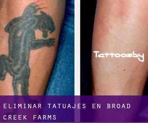 Eliminar tatuajes en Broad Creek Farms