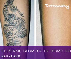 Eliminar tatuajes en Broad Run (Maryland)