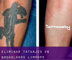 Eliminar tatuajes en Broadlands (Limpopo)