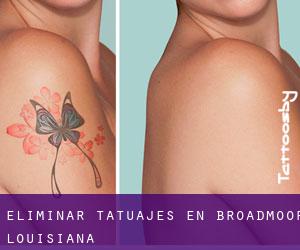 Eliminar tatuajes en Broadmoor (Louisiana)
