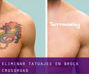 Eliminar tatuajes en Brock Crossroad