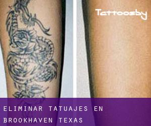 Eliminar tatuajes en Brookhaven (Texas)